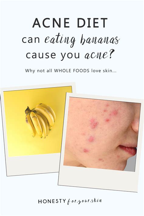 Do Bananas Cause Acne Will Eating One Flare Yours