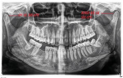 Figure 2 From Assessment Of Mandibular Condylar Morphology Using Digital Orthopantomogram In