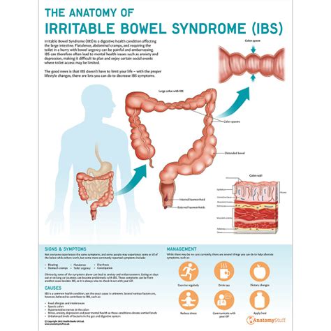 The Anatomy Of Irritable Bowel Syndrome Ibs Chart Anatomystuff