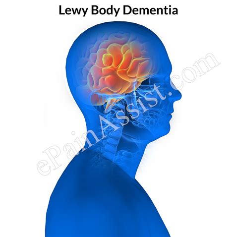 Lewy Body Dementiasymptomscausesdiagnosistreatment Medication