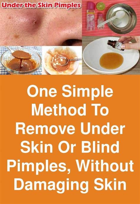 One Simple Method To Remove Under Skin Or Blind Pimples Without