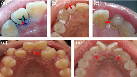 An update on the diagnosis and treatment of dens invaginatus - Zhu ...