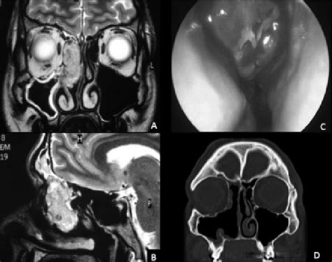 A B Coronal And Sagittal T2 Weighted Images Pre Operative Mri Shows A