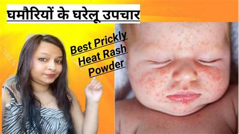 Heat Rash In Babies घमौरियों का घरेलू उपचार Best Heat Rash Powder