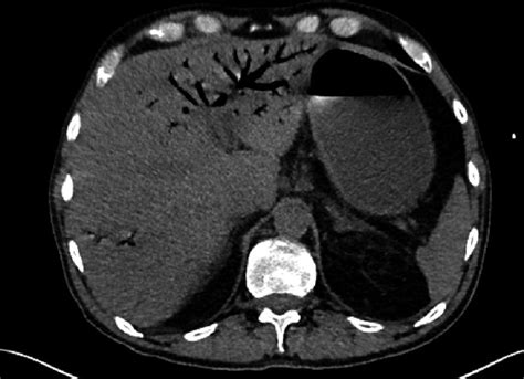 Hepatic Portal Venous Gas Soon 2015 Clinical Case Reports Wiley