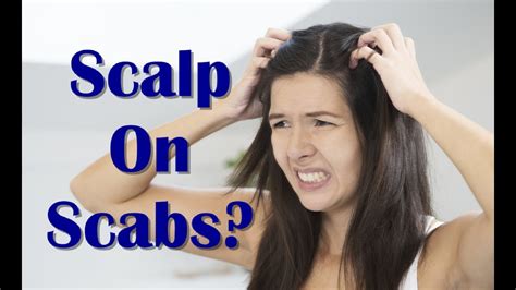 How To Treat Scalp Scabs Naturally Home Remedies For Scalp Scabs Youtube