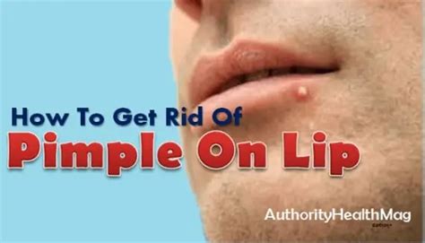 How To Get Rid Of Pimple On Lip Best Remedies For Bump On Lip