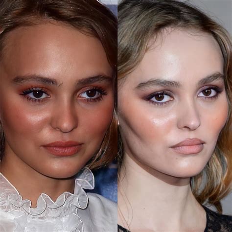 Did Lily Rose Depp Have Plastic Surgery