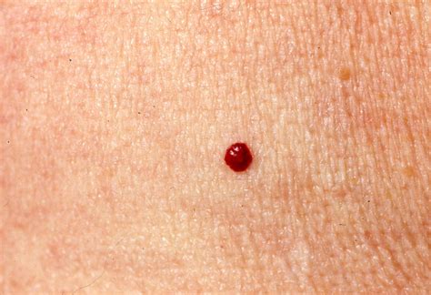 Cherry Angioma Symptoms，causes And Treatments Md