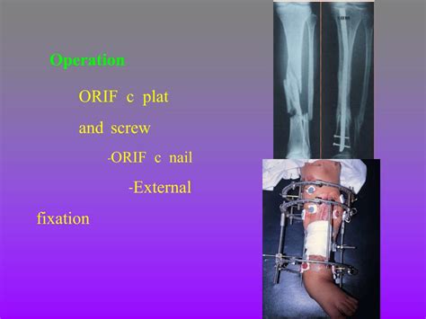 Ppt Fracture Tibia And Fibula Powerpoint Presentation Free Download