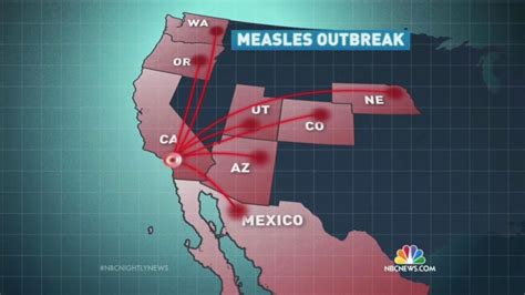 Even One Vaccination Works Five Things To Know About Measles