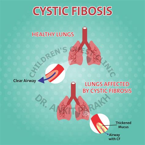 Lung Problems In Cystic Fibrosis Symptoms And Causes Dr Ankit Parakh