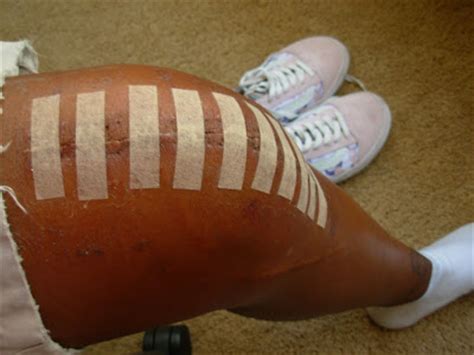 It can be a complex surgical procedure. BLACK PEOPLE DON'T SURF: April 2009