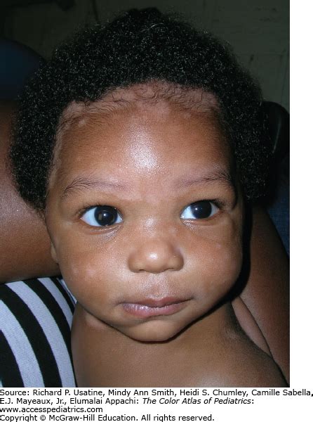 Eczema On Black Babies