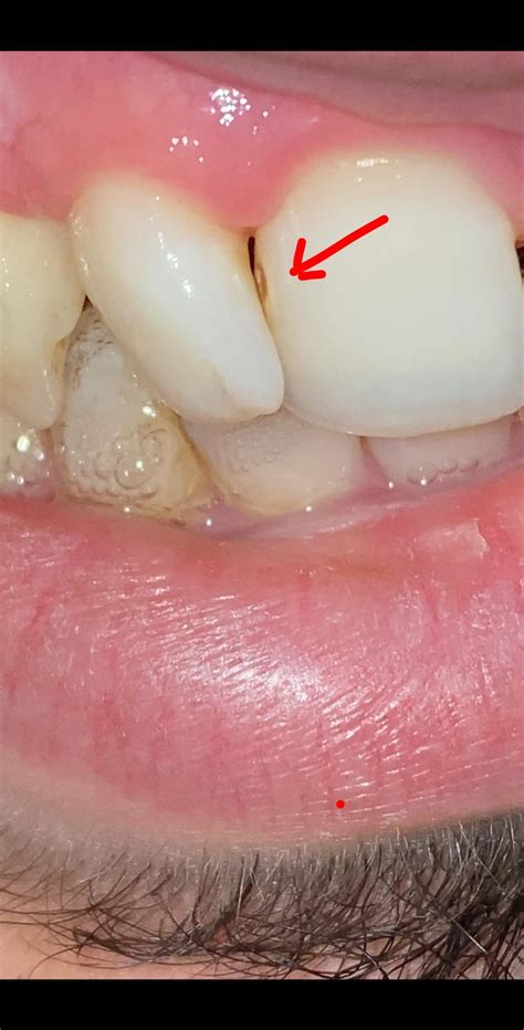 I Noticed A Hole Between My Front Teeth Is This A Cavity Or A Stain I