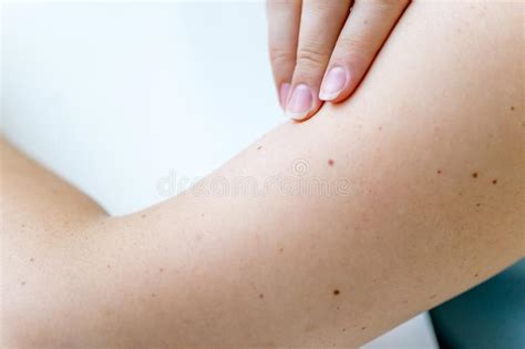 A Birthmark Or A Mole On A Woman Skin Stock Photo Image Of Beautiful