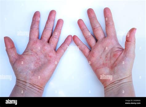 Dermatitis Atópica Manos Rojas Problema Dermatológico Manos