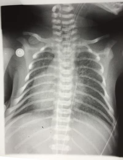 What Is A Chest Xray Two Views