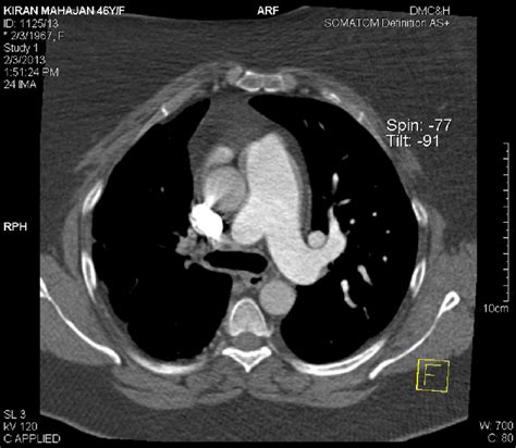 E Ct Pulmonary Angio Showing Absent Right Pulmonary Artery Download