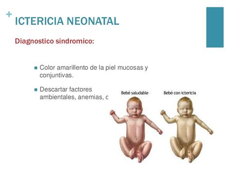 Cid 10 Ictericia Neonatal