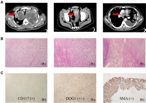 Preoperative Contrast Enhanced Ct Images And Postoperative Histology