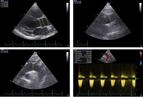 Echocardiographic Examination Of Aortic Dimension In A 14‐year‐old