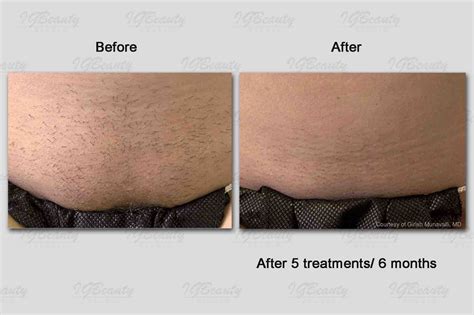 Brazilian Laser Hair Removal Before And After Photos Hair Style Blog