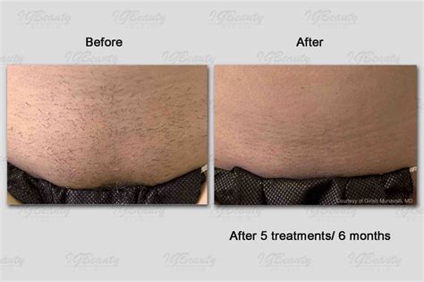 Laser Bikini Brazilian Hair Removal Procedure Cost Results