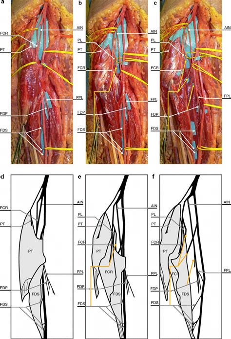 Left Forearm Ac Progressive Dissection Of The Median Nerve