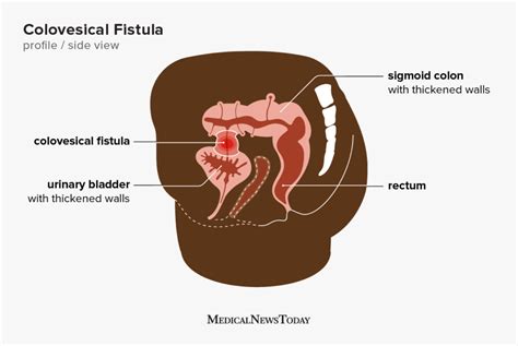 Colovesical Fistula What Occurs Symptoms And Causes