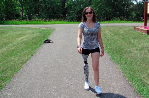 Patient Stories Tillges Certified Orthotic Prosthetic Inc