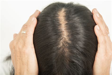 Intradermal Minoxidil Injections For The Treatment Of Androgenetic Alopecia In Women