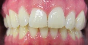 Incisor sticking out with misshapen front teeth photo from ...