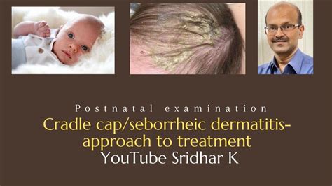 Cradle Cap Seborrhoeic Dermatitis Approach To Treatment Of Cradle Cap