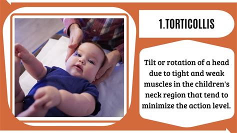 Ppt Get Torticollis Physical Therapists Now Powerpoint Presentation Id11402361