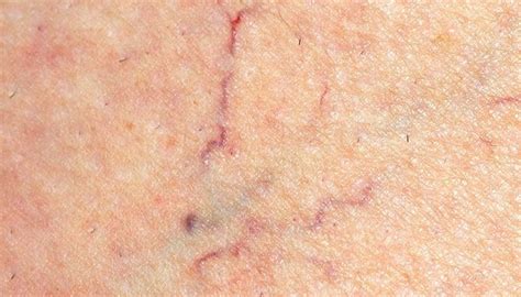 Spider Veins Causes Treatment And Prevention