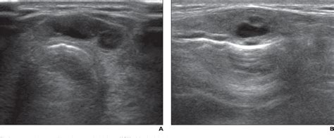 Figure 1 From Ultrasound Findings Of Papillary Thyroid Carcinoma