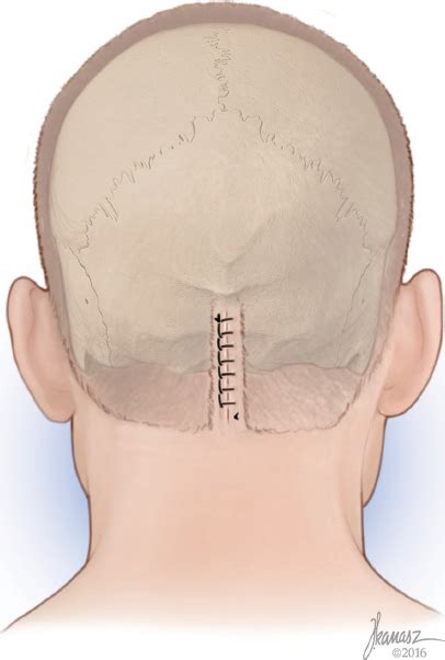 Detection Of Migraine Headache Trigger Sites Plastic Surgery Key