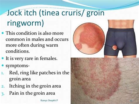 Rash In Groin Area Female Inverse Psoriasis Or Jock Itch Symptoms