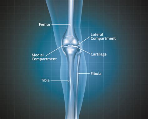 Knee Osteoarthritis Thuasne