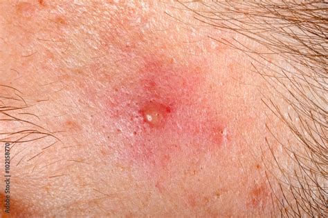 Nodular Cystic Acne Skin Stock Photo Adobe Stock