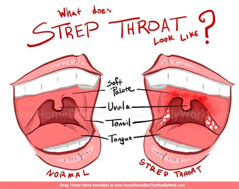 The 25 Best Signs Of Strep Throat Ideas On Pinterest Strep Throat