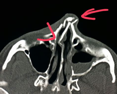 Radiological anatomy is crucial for radiologists and forms the base for learning radiology. #Face #CT shows #nasal #fractures (arrow) and nasal # ...