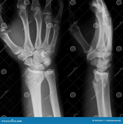 X Ray Image Of Wrist Joint Ap And Lateral View Stock Image Image