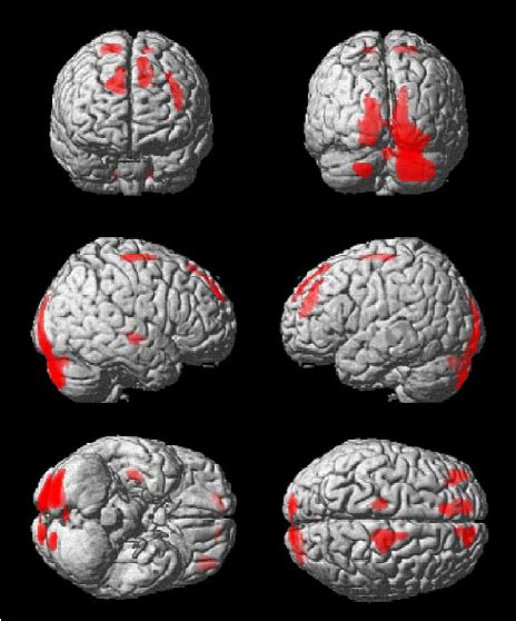 Regions Of Increased Grey Matter Volume At Baseline In 41 Fes Patients