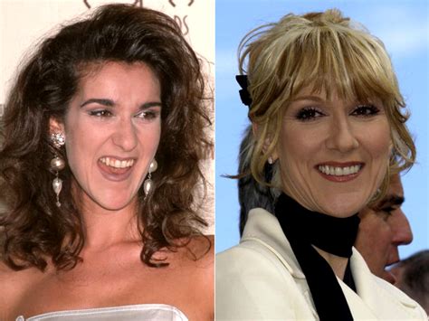 Celine Dion Veneers Before And After Becomegorgeous Com
