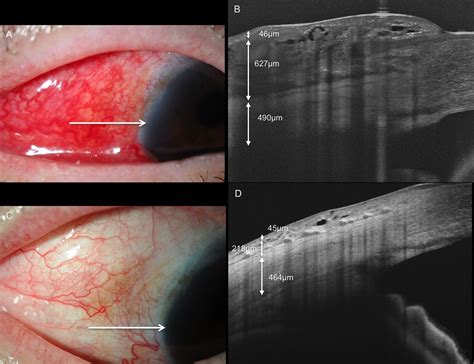 Morphological Features In Anterior Scleral Inflammation Using Swept