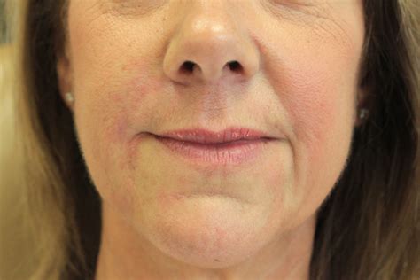 Juvederm Ultra Xc Used To Fill Lines Around The Mouth