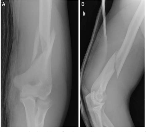 Pdf Surgical Fixation Of Extra Articular Distal Humerus Fractures With A Posterolateral Plate