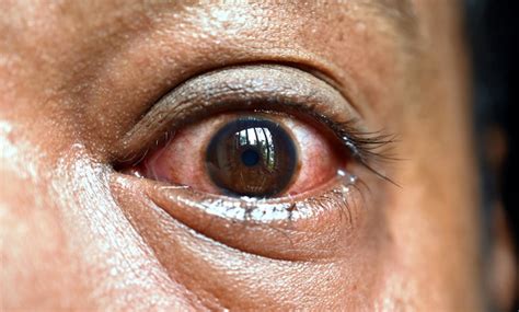 Mucormycosis Black Fungus Infection In Eye Facts And Myths